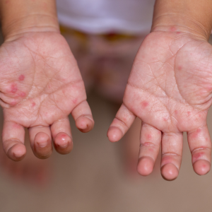 Kind zeigt die Hände mit den Bläschen einer Hand-Mund-Fuß-Krankheit